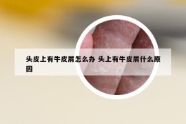 頭皮上有牛皮屑怎么辦 頭上有牛皮屑什么原因