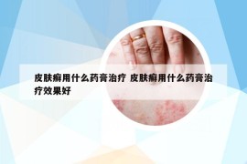 皮膚癬用什么藥膏治療 皮膚癬用什么藥膏治療效果好