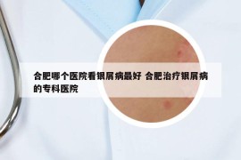 合肥哪個醫(yī)院看銀屑病最好 合肥治療銀屑病的?？漆t(yī)院