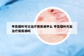 甲氨蝶呤可以治療銀屑病甲么 甲氨蝶呤片能治療銀屑病嗎