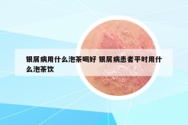 銀屑病用什么泡茶喝好 銀屑病患者平時用什么泡茶飲