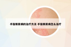手指銀屑病的治療方法 手指銀屑病怎么治療