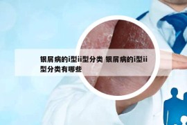 銀屑病的i型ii型分類 銀屑病的i型ii型分類有哪些