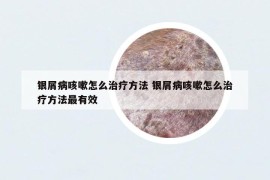 銀屑病咳嗽怎么治療方法 銀屑病咳嗽怎么治療方法最有效
