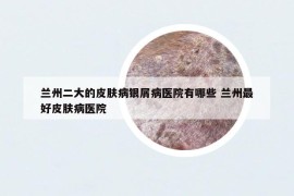 蘭州二大的皮膚病銀屑病醫(yī)院有哪些 蘭州最好皮膚病醫(yī)院