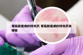 掌跖膿皰病的特效藥 掌跖膿皰病的特效藥有哪些