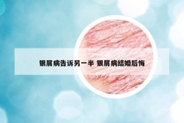 銀屑病告訴另一半 銀屑病結(jié)婚后悔