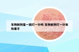 生物制劑是一回打一針嗎 生物制劑打一針有效果不