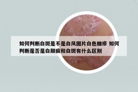 如何判斷白斑是不是白風(fēng)圖片白色糠疹 如何判斷是否是白顛瘋和白斑有什么區(qū)別