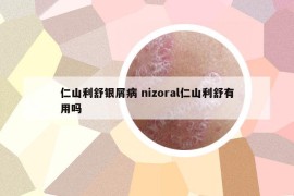 仁山利舒銀屑病 nizoral仁山利舒有用嗎