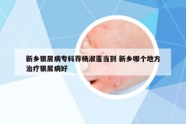 新鄉(xiāng)銀屑病專科薦楊淑蓮當?shù)?新鄉(xiāng)哪個地方治療銀屑病好