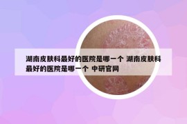 湖南皮膚科最好的醫(yī)院是哪一個(gè) 湖南皮膚科最好的醫(yī)院是哪一個(gè) 中研官網(wǎng)