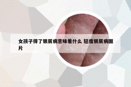 女孩子得了銀屑病意味著什么 輕度銀屑病圖片