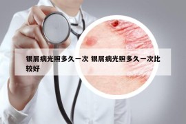 銀屑病光照多久一次 銀屑病光照多久一次比較好