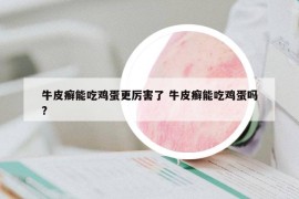 牛皮癬能吃雞蛋更厲害了 牛皮癬能吃雞蛋嗎?