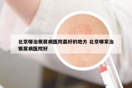 北京哪治銀屑病醫(yī)院最好的地方 北京哪家治銀屑病醫(yī)院好