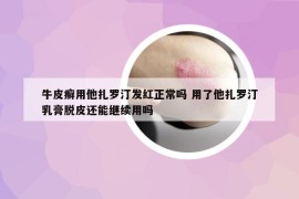 牛皮癬用他扎羅汀發(fā)紅正常嗎 用了他扎羅汀乳膏脫皮還能繼續(xù)用嗎