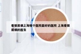 看銀屑病上海哪個(gè)醫(yī)院最好的醫(yī)院 上?？淬y屑病的醫(yī)生