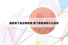 胳肢窩下面會銀屑病 腋下銀屑病有什么癥狀