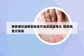 銀屑病吃迪銀氨肽素片加皮膚血毒丸 銀屑病復(fù)方氨肽