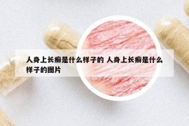 人身上長癬是什么樣子的 人身上長癬是什么樣子的圖片