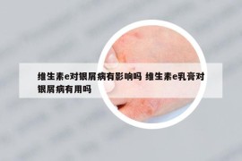 維生素e對銀屑病有影響嗎 維生素e乳膏對銀屑病有用嗎