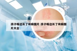 孩子嘴邊長了塊癬圖片 孩子嘴邊長了塊癬圖片大全