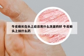 牛皮癬長(zhǎng)在頭上應(yīng)該用什么洗面奶好 牛皮癬頭上抹什么藥
