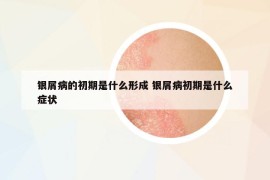 銀屑病的初期是什么形成 銀屑病初期是什么癥狀