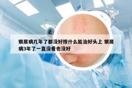 銀屑病幾年了都沒好擦什么能治好頭上 銀屑病3年了一直沒看也沒好
