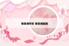銀屑病環(huán)形 銀屑病圓圈