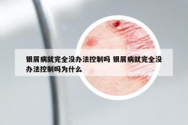 銀屑病就完全沒(méi)辦法控制嗎 銀屑病就完全沒(méi)辦法控制嗎為什么