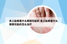 身上起癬是什么原因引起的 身上起癬是什么原因引起的怎么治療