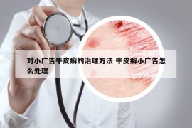 對小廣告牛皮癬的治理方法 牛皮癬小廣告怎么處理