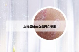 上海最好的白癜風在哪里