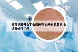 銀屑病父母會不會遺傳嗎 父母有銀屑病,會遺傳給孩子嗎