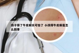 孩子得了牛皮癬太可怕了 小孩得牛皮癬是怎么回事