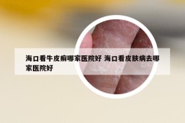 ?？诳磁Ｆぐ_哪家醫(yī)院好 ?？诳雌つw病去哪家醫(yī)院好