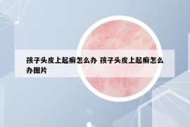 孩子頭皮上起癬怎么辦 孩子頭皮上起癬怎么辦圖片