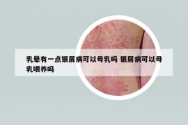 乳暈有一點銀屑病可以母乳嗎 銀屑病可以母乳喂養(yǎng)嗎