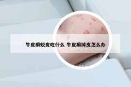 牛皮癬蛻皮吃什么 牛皮癬掉皮怎么辦