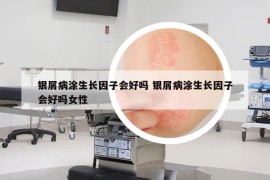 銀屑病涂生長(zhǎng)因子會(huì)好嗎 銀屑病涂生長(zhǎng)因子會(huì)好嗎女性