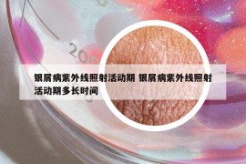 銀屑病紫外線照射活動(dòng)期 銀屑病紫外線照射活動(dòng)期多長(zhǎng)時(shí)間