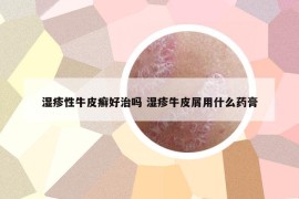 濕疹性牛皮癬好治嗎 濕疹牛皮屑用什么藥膏
