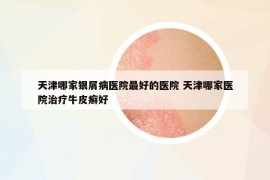 天津哪家銀屑病醫(yī)院最好的醫(yī)院 天津哪家醫(yī)院治療牛皮癬好