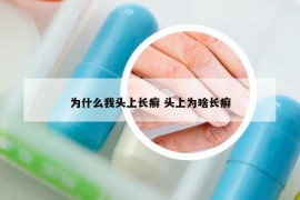 為什么我頭上長(zhǎng)癬 頭上為啥長(zhǎng)癬