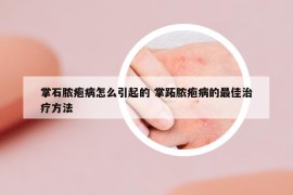 掌石膿皰病怎么引起的 掌跖膿皰病的最佳治療方法