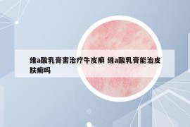 維a酸乳膏害治療牛皮癬 維a酸乳膏能治皮膚癬嗎