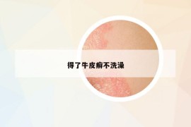 得了牛皮癬不洗澡