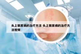 頭上銀屑病的治療方法 頭上銀屑病的治療方法視頻